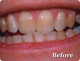 Cosmetic before